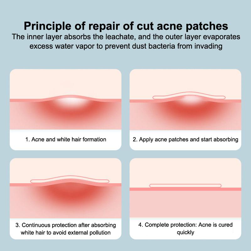 1 Set Extra Thin Waterproof Soft Disposable Bordered Hydrocolloid Dressing Wound Band Aid Medical Hydrocolloid Dressing