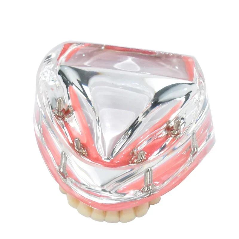 Modello Denti Dentali Trasparente 4 Impianti Overdenture Ponte Rimovibile Modello Mandibolare Inferiore M6003 Materiali per Studio Dentistico