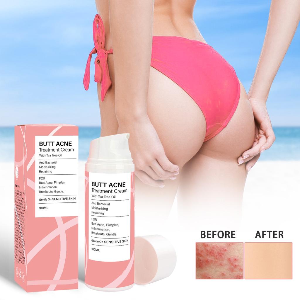 Krém na akné na zadek Účinně na akné Folikulitida, Krém na akné na hýždě Hydratační krém na hýždě snižuje akné na těle