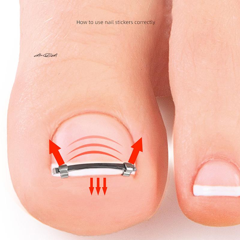 Ingrown Toenail Pedicure Tool - Curved Clamp Toe Nail Care Straightening Correction Clip for Toes - Embed Nail Care Tool