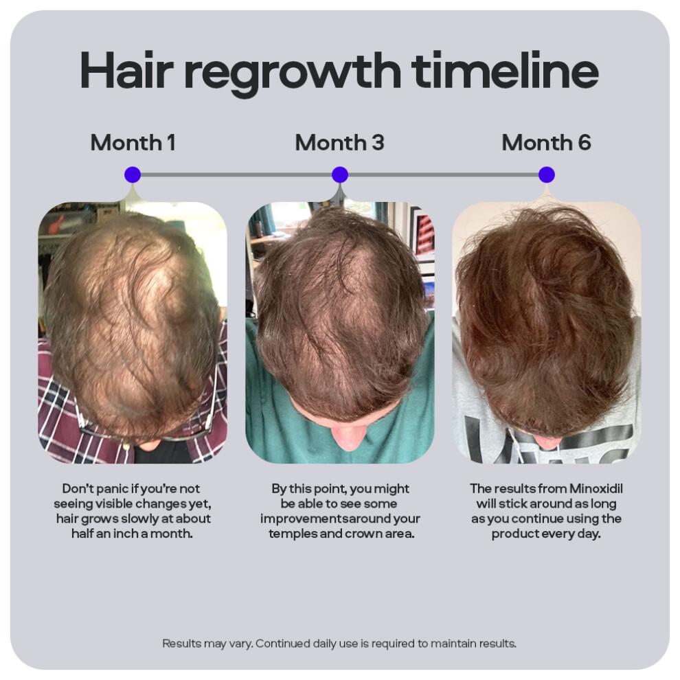 Sons Minoxidil 5% e Derma Roller, 3 Mesi