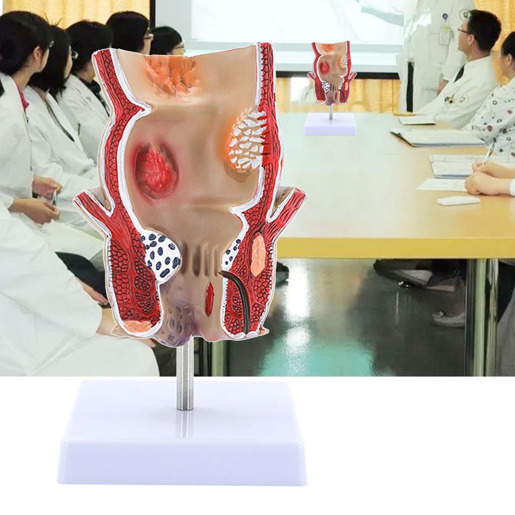Human Pathologies of Rectum Model Medicals Teaching Tool Human Rectum Model Human Anatomy Model Teaching Supplies