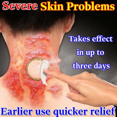 Herbal Dermatitis Gel - Soothes Eczema & Common Skin Problems Gentle for Daily Use
