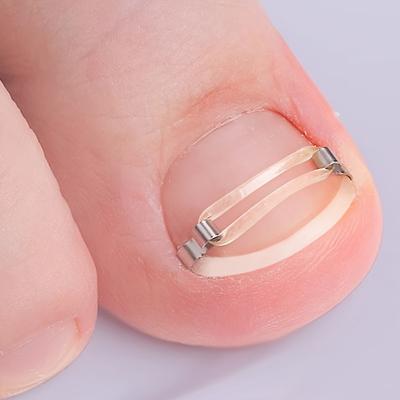 Kit para uñas encarnadas: aparato ortopédico, elevador y almohadillas para aliviar el dolor de las uñas, recomendado por podólogos