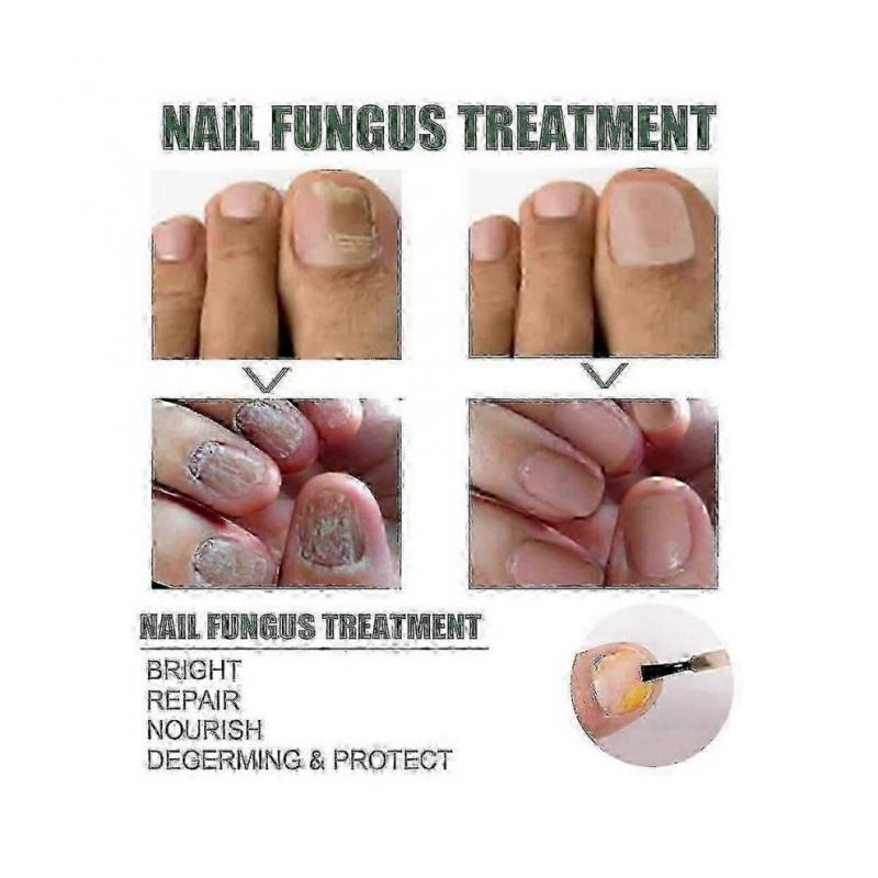 (2pcs)EELHOE Nail Repair Liquid Gray Nail Liquid Uneven Thick Nail Thickening Gray Nail Soft Nail Hand and Foot Repair Liquid