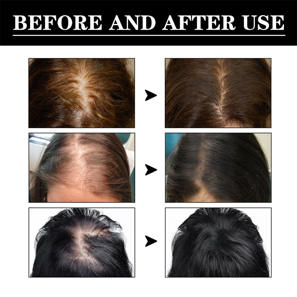 Haarpflege Haarwachstum Ätherische Öle Essenz Verhindern Sie Haarausfall Flüssigkeit Gesundheitspflege Schönheit Dichtes Haarwachstumsserum