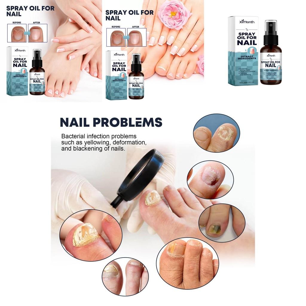 Ximonth Nail Care Spray Nourishing Moisturizing Solution For Strong Healthy Nails 30ml