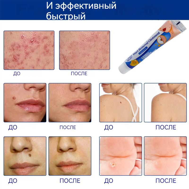 ZB Mole Removal Ointment Skin Care Mild Ingredients Collagen Daily Skin Care