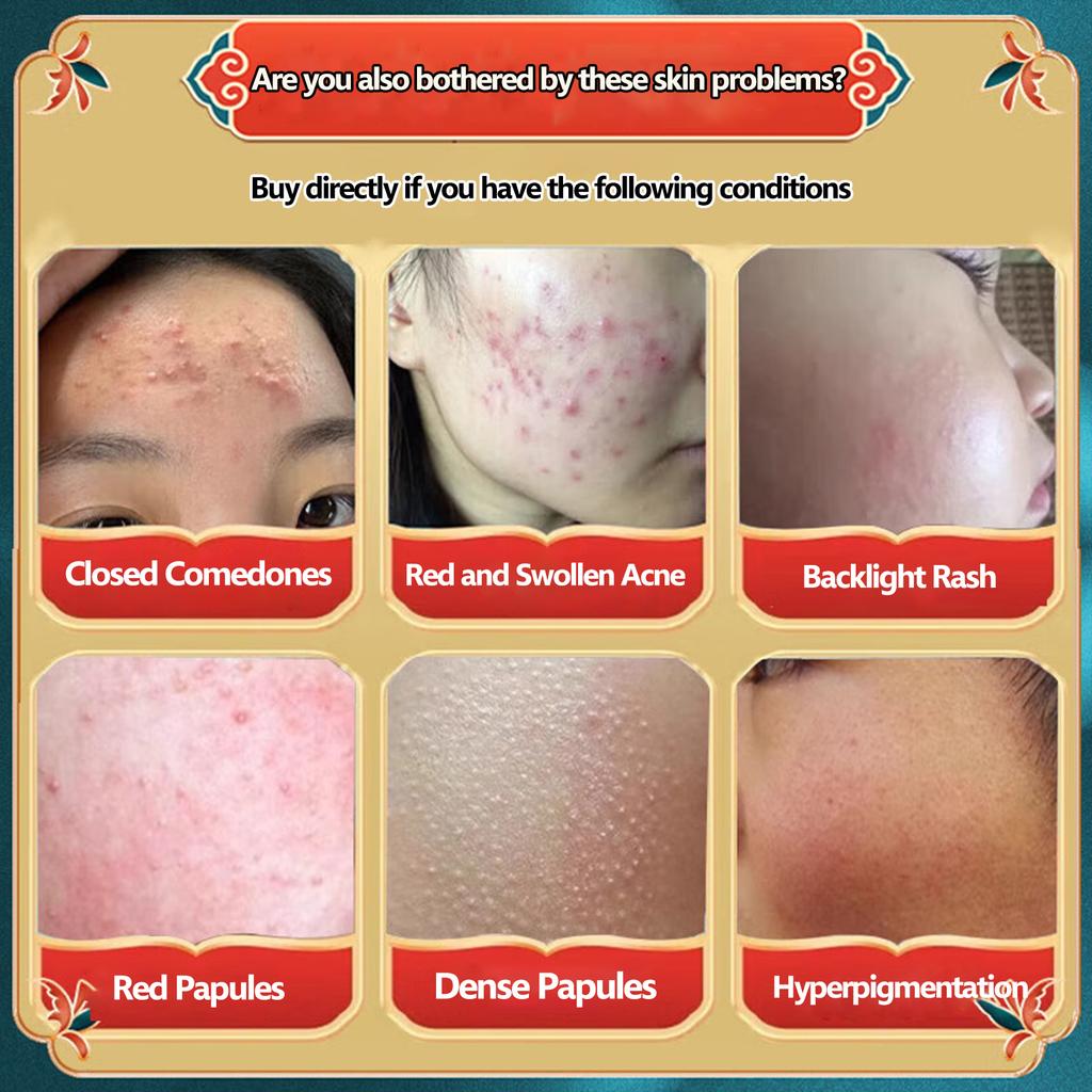 Acne-Clearing Cream-Natural Extraction+Pore-Shrinking+Blackhead-Removing,Acne-Prone Skin Daily Care & Post-Acne Pore/Blackhead Improvement