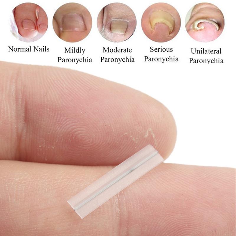 Ingrown Toenail Correction Tool Straightening Clip Brace Ingrown Toe Nail Treatment Elastic Patch Sticker Pedicure Tool