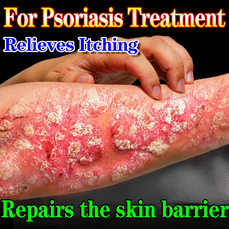 Cowhide Moss Care Cream To Relieve Hand and Foot Skin Itching Discomfort Moisturizing Skin Cool Care Cream