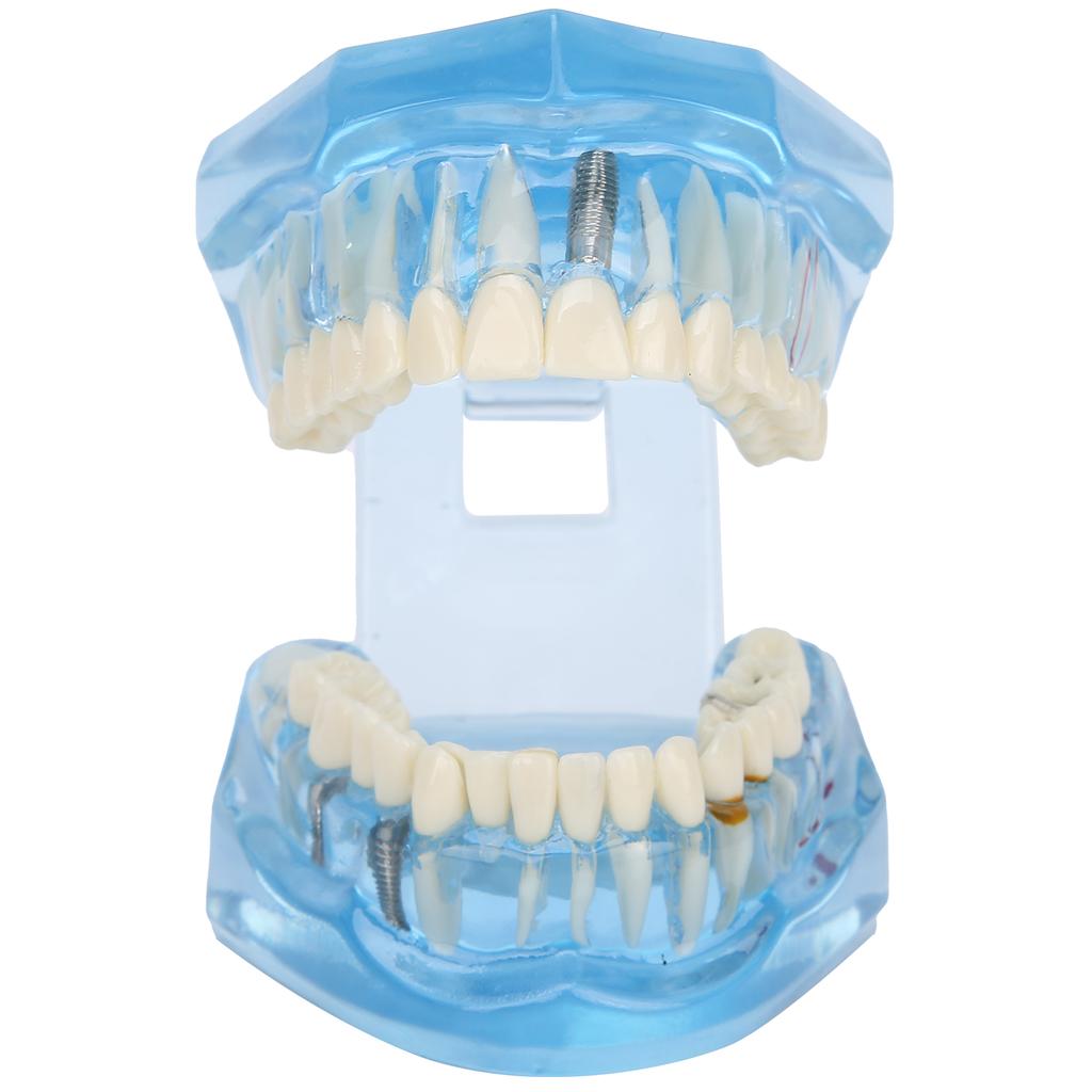 Dental Teeth Model Acrylic Blue Transparent Teaching Demonstration Simulation Teeth Model