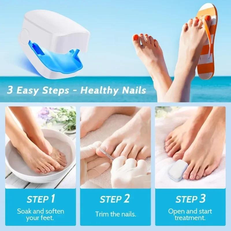Effective Remover Fungus Machine Repair Nail Laser Fungus Device Damage Rechargeable Cleaning Nail Phototherapy Auxiliary Tools
