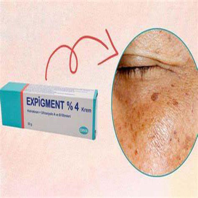 Expigment 4% Skin Whiteing Spot Remover Léčba akné