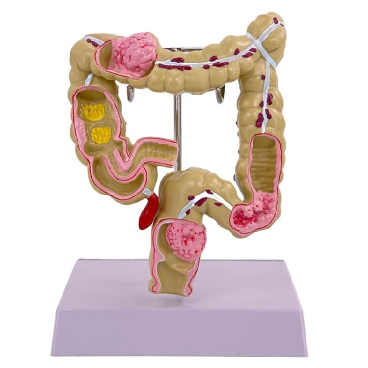 

Human Pathologies of Large Intestine Model Medicals Teaching Tool Human Large Intestine Model Human Anatomy Model 1