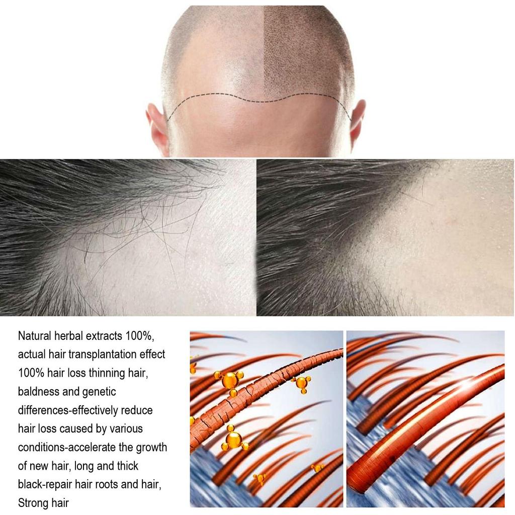 Schnelles Haarwachstum Serum Spray Gegen Haarausfall Vorbeugung von Kahlheit Kopfhautbehandlung Reparatur der Wurzeln Schönheit Gesundheit Haarpflege Für Männer Frauen