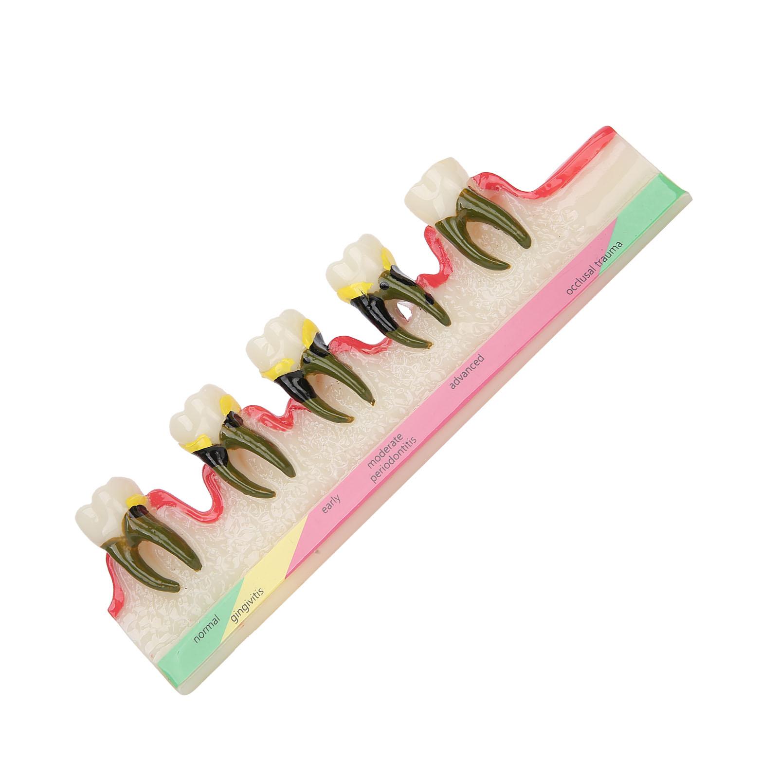 

Dental Periodontal Disease Model Tooth Disease Study Teaching Model for Dental School