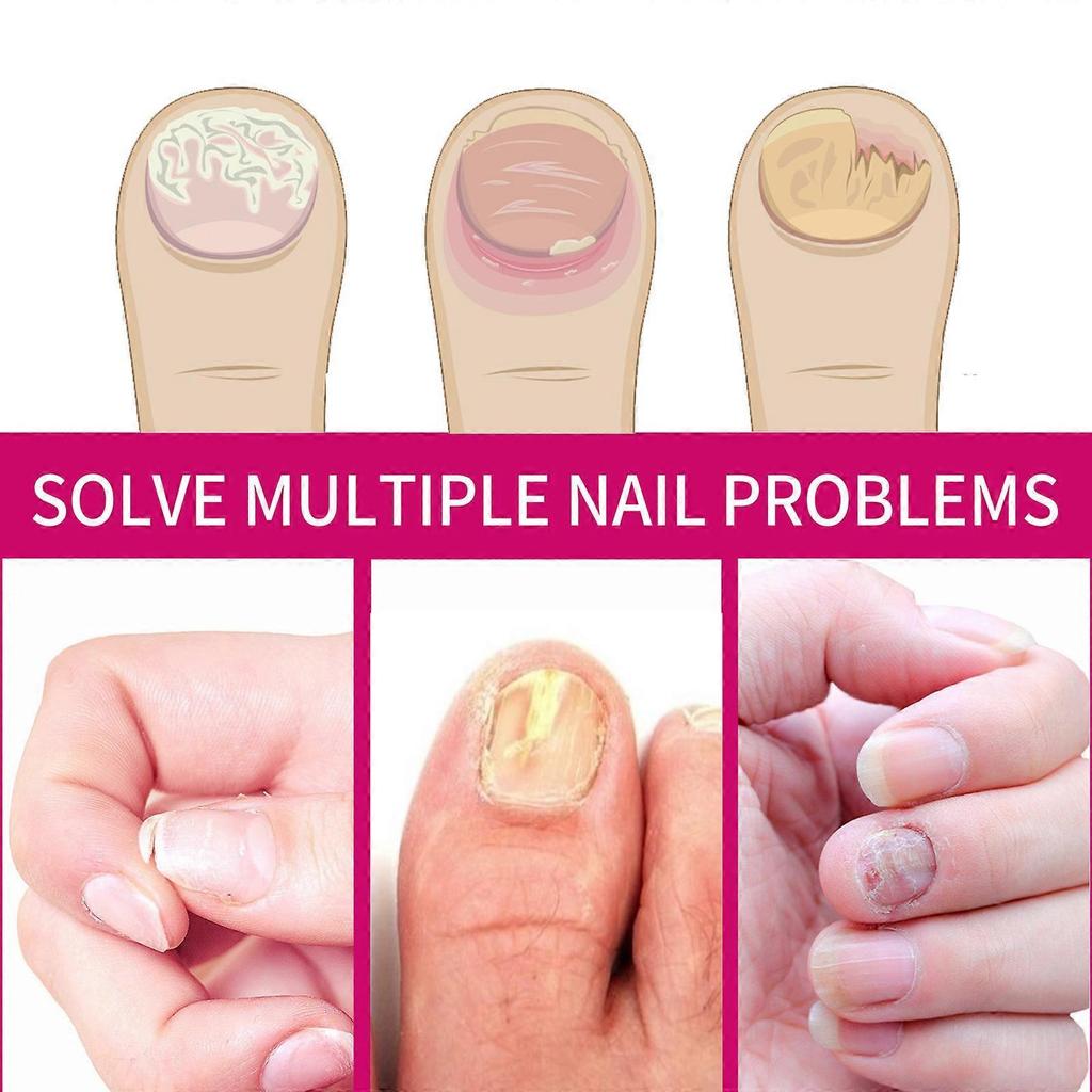 1-5x OUHOE Ingwer Nagelpflege Essenz, Graue Nägel Feuchtigkeitspflege Peeling Schönheitsnagel Essenz