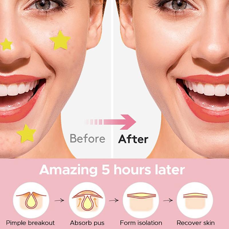 360Pcs Heart Star Face Skin Care Acne Pimple Patch Invisible Professional Healing