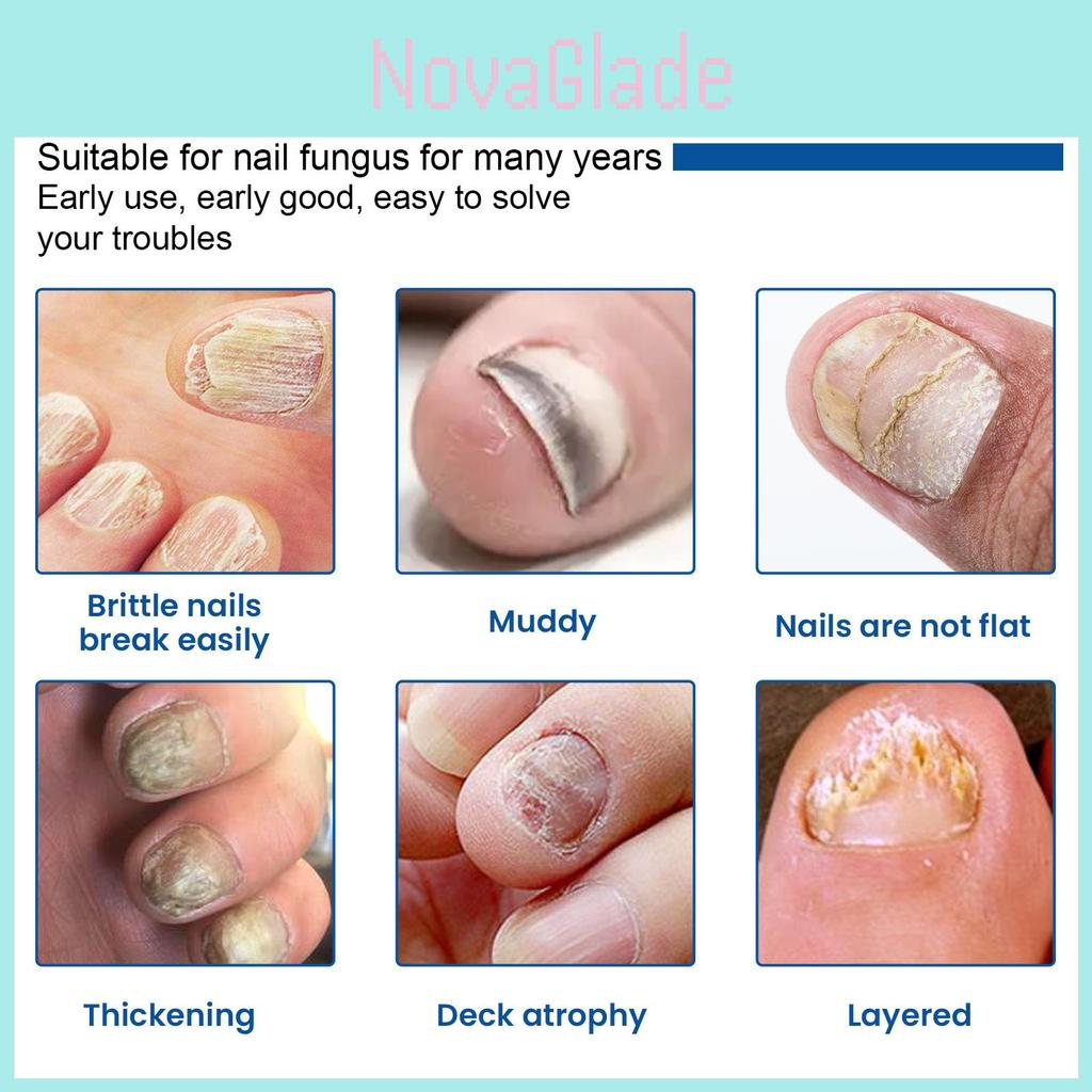 Ximonth Nail Care Patches Repairing Thickening Strengthening For Damaged Nails