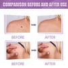Eelhoe Body Mole Removal Pen Effective Skin Tag Remover For Face Hands And Neck