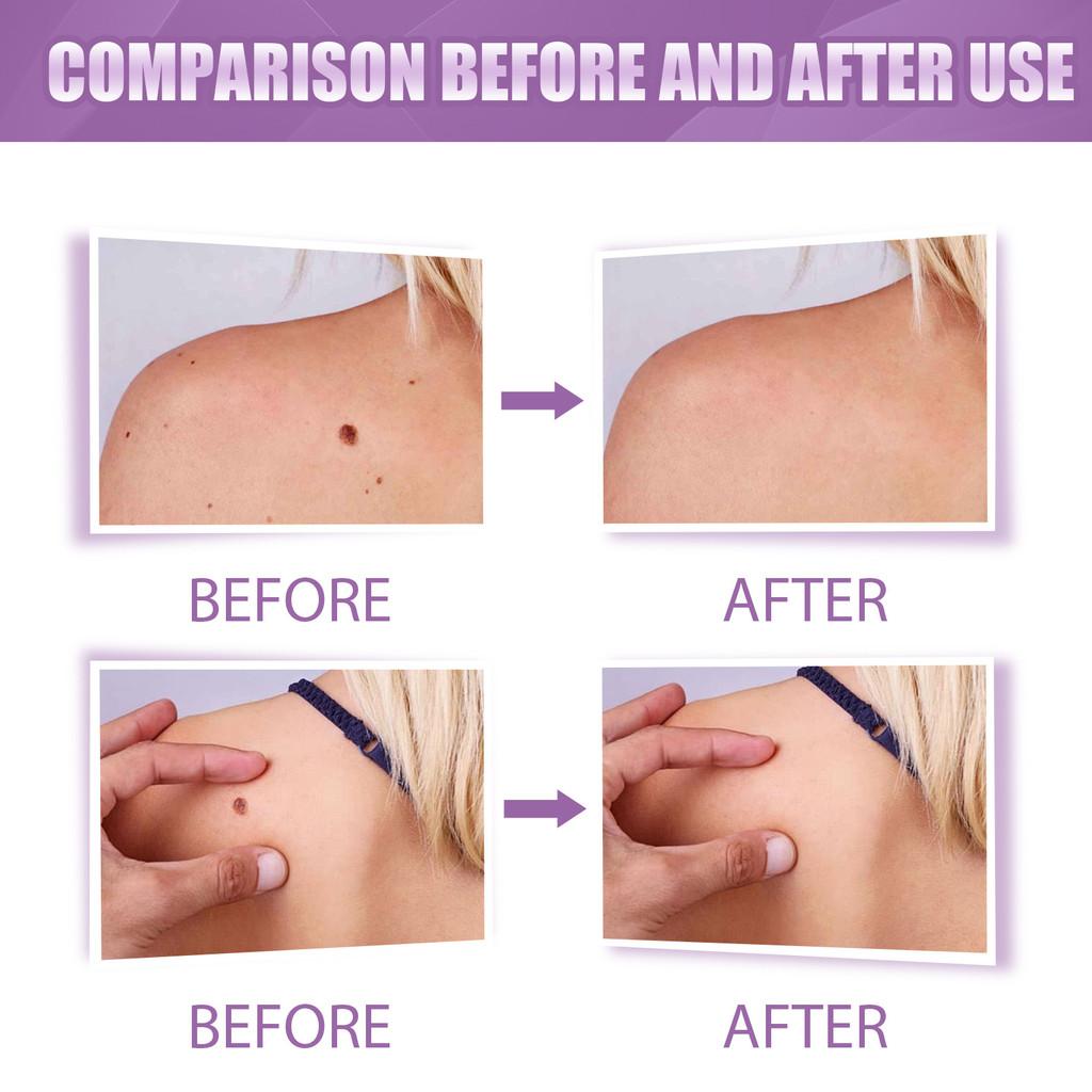 Eelhoe Body Mole Removal Pen Effective Skin Tag Remover For Face Hands And Neck