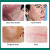 Breylee Acne Scar Removal Cream Stretch Marks Treatment Repairing Skin Care