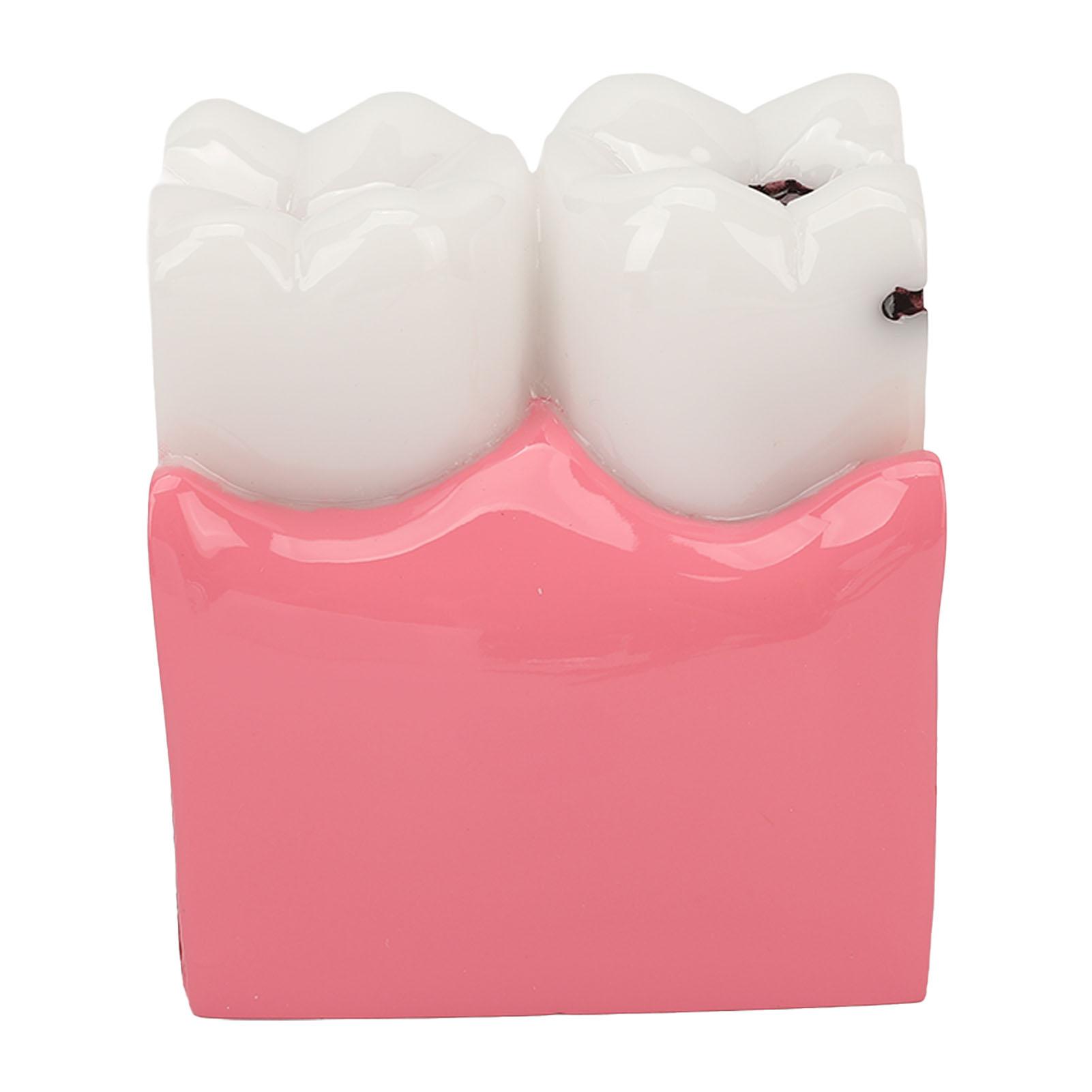 

Модель кариеса зуба 6X Демонстрационная модель распада для учебных лабораторий