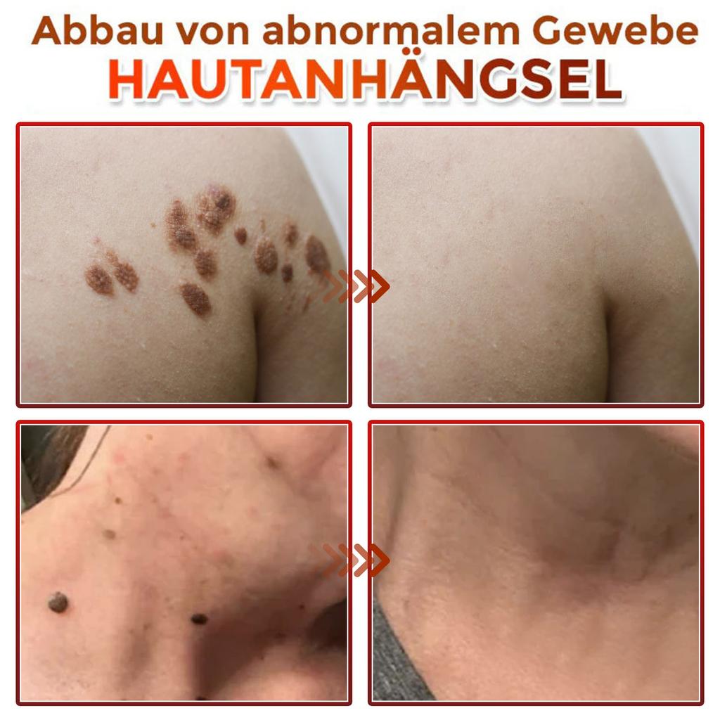 Adesivo de Microagulhas para Remoção de Nevo da Pele para Redução de Manchas Planas Faciais e Cuidados com os Olhos.