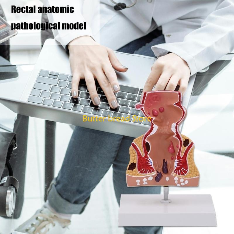 W89C Human Pathologies of Rectum Model Medicals Teaching Tool Human Rectum Model Human Anatomy Model Teaching Supplies