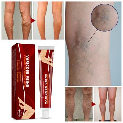 Pâte pour varices, pâte pour varices, varices et varicosités soulagent les jambes, améliorent la circulation sanguine