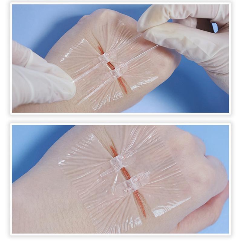 1/2Pcs Zipper Tie Wound Closure Patch Hemostatic Patch Wound Fast Suture Zipper Band-Aid Outdoor Portable