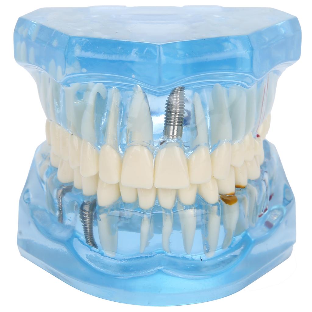 Dental Teeth Model Acrylic Blue Transparent Teaching Demonstration Simulation Teeth Model