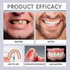 1/2/3x Advanced Customized Full Denture Set, Silicone Reline Denture Set