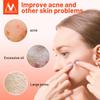 Effektiv aknefjerningskrem Aknebehandling blekne Akneflekker Oljekontroll Krympe porer Whitening Fuktighetsgivende aknekrem Hudpleie
