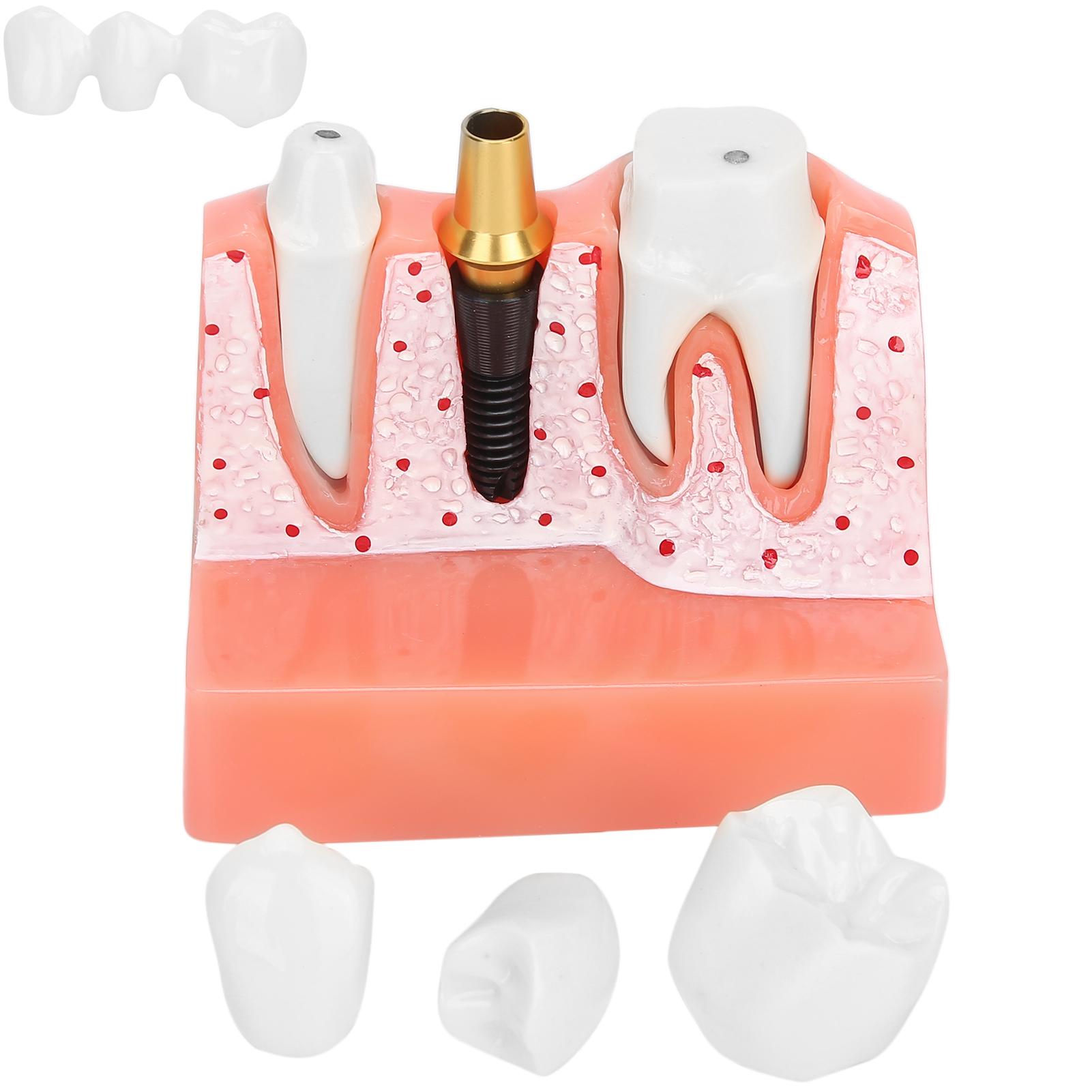 

Teeth Model Dental Implant Analysis Crown Bridge Model Demonstration Tooth Model