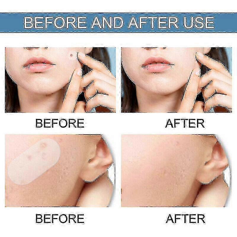 320pcs Large Acne Patch Pimple Hydrocolloid Stickers Spot Cover Remover Treatment