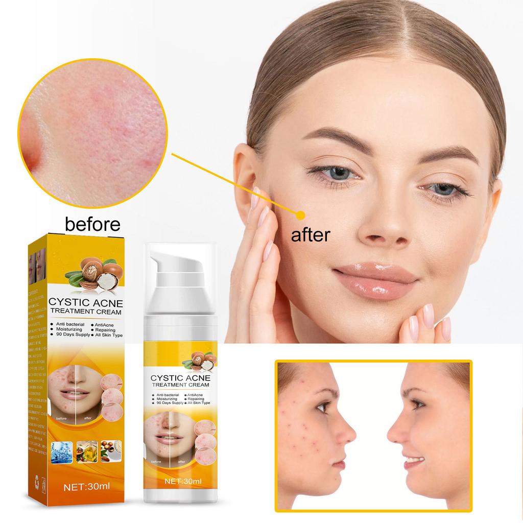 Cystic, Hormonal And Severe Acne Treating Cream Spray For Adolescent And Adult Acne Skin Care 30ml