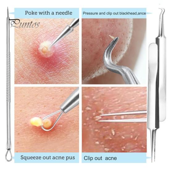 Dermatologist Recommended Skincare Tools 9Pcs Blackhead Remover Kit Stainless Steel Pimple Extractor Set with Storage Box Pore Cleaning Professional