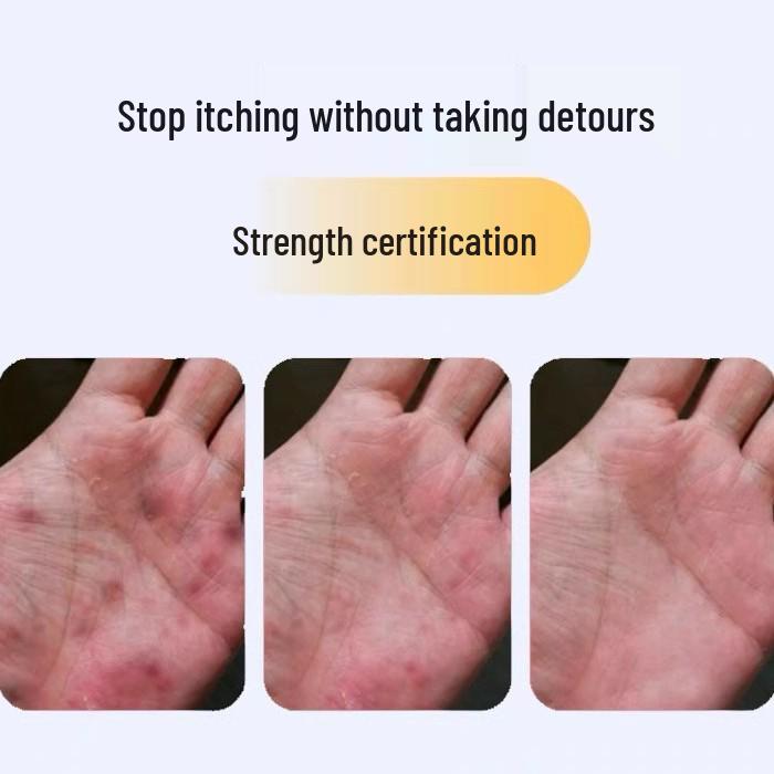 Yunnan Fungal King Skin Itch Relief Cream for Dry, Cracked Heels and Hard Skin Prevention