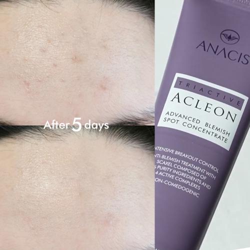 Acleon Youth Acne Skincare Ampoule & Spot Treatment Duo