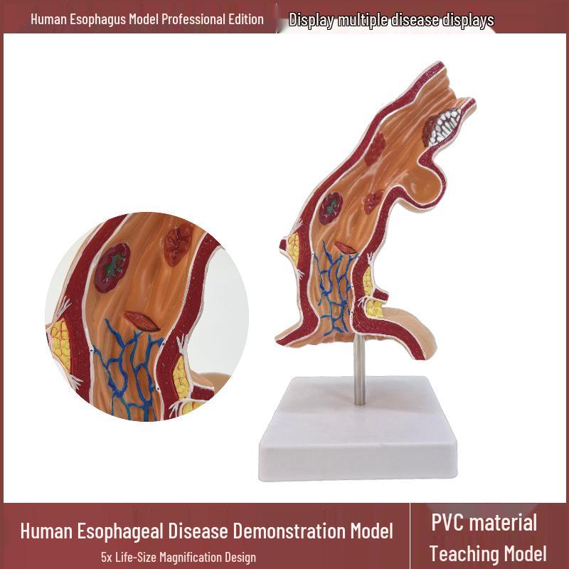 Esophageal Disease & Anatomy Model for Gastroenterology and Respiration Teaching