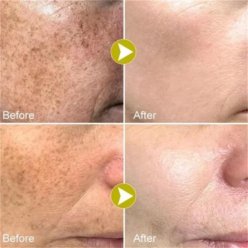 Whiten Cream Brighten Face Effective Remove Melasma Dark Spot Improve Dullness Skin Anti-pigmentation Care Cream Care Products