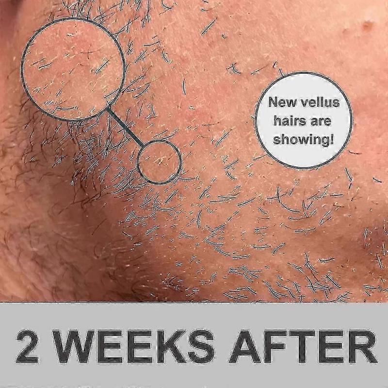 Beard Growth Kit, Beard Derma Roller 0.3mm, Beard Oil For Facial Hair Growth For Men And Dads, Grooming Tool - Quan