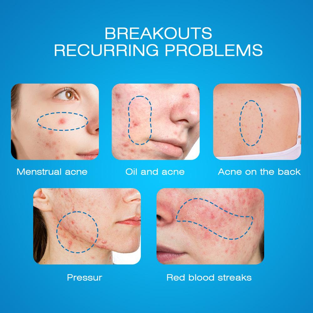 Sumifun Освітлюючий крем від шрамів від вугрової висипки, темних крапок і плям 20 г