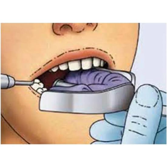 GDC Dentulous Non-Perforated Impression Trays Upper # 1 (Itrldnpu1)