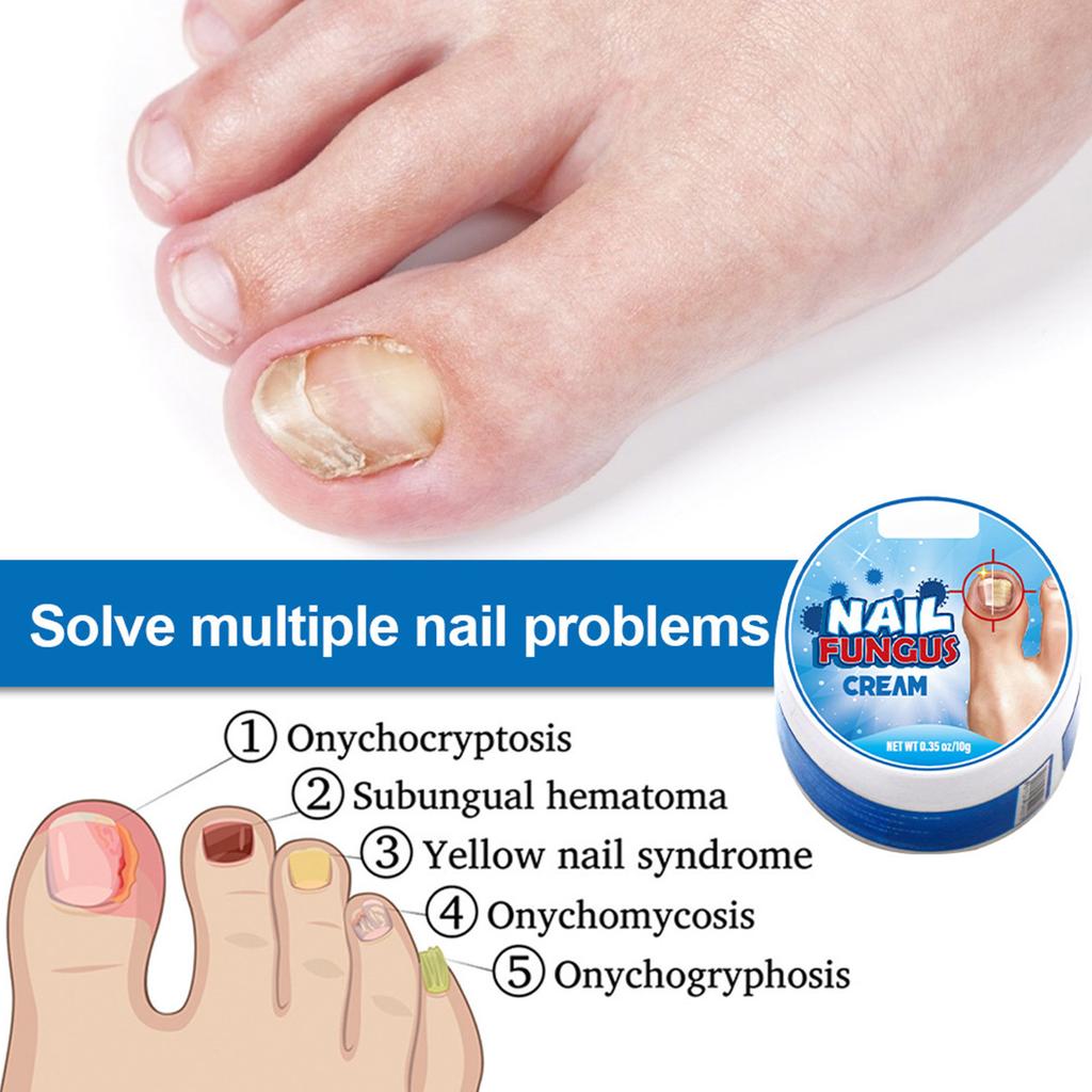 Gips Ny Bright Nail Plaster Lindrer Onychomycosis Og Neglepleie