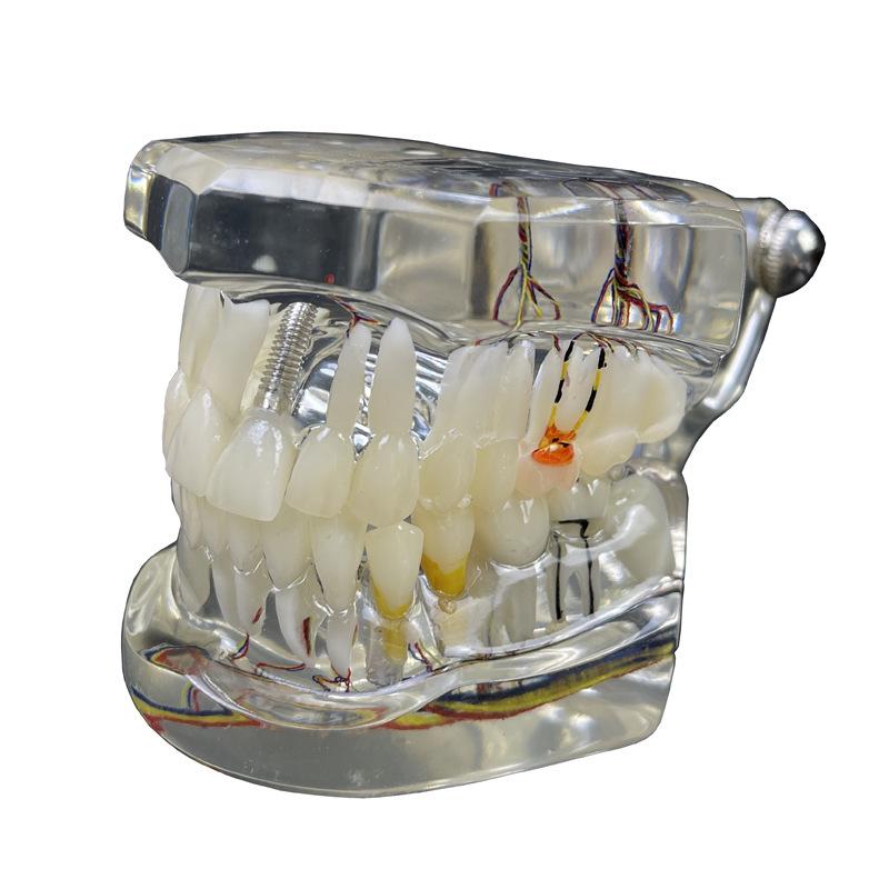 Прозора Знімна Повна Модель Щелепи з М'якими Яснами та Зубами для Підготовки до Імплантації
