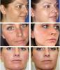 Crème blanchissante efficace contre les taches de rousseur, élimine les taches d'acné mélasma, pigment mélanine, taches foncées, hydratant, soins pour la peau