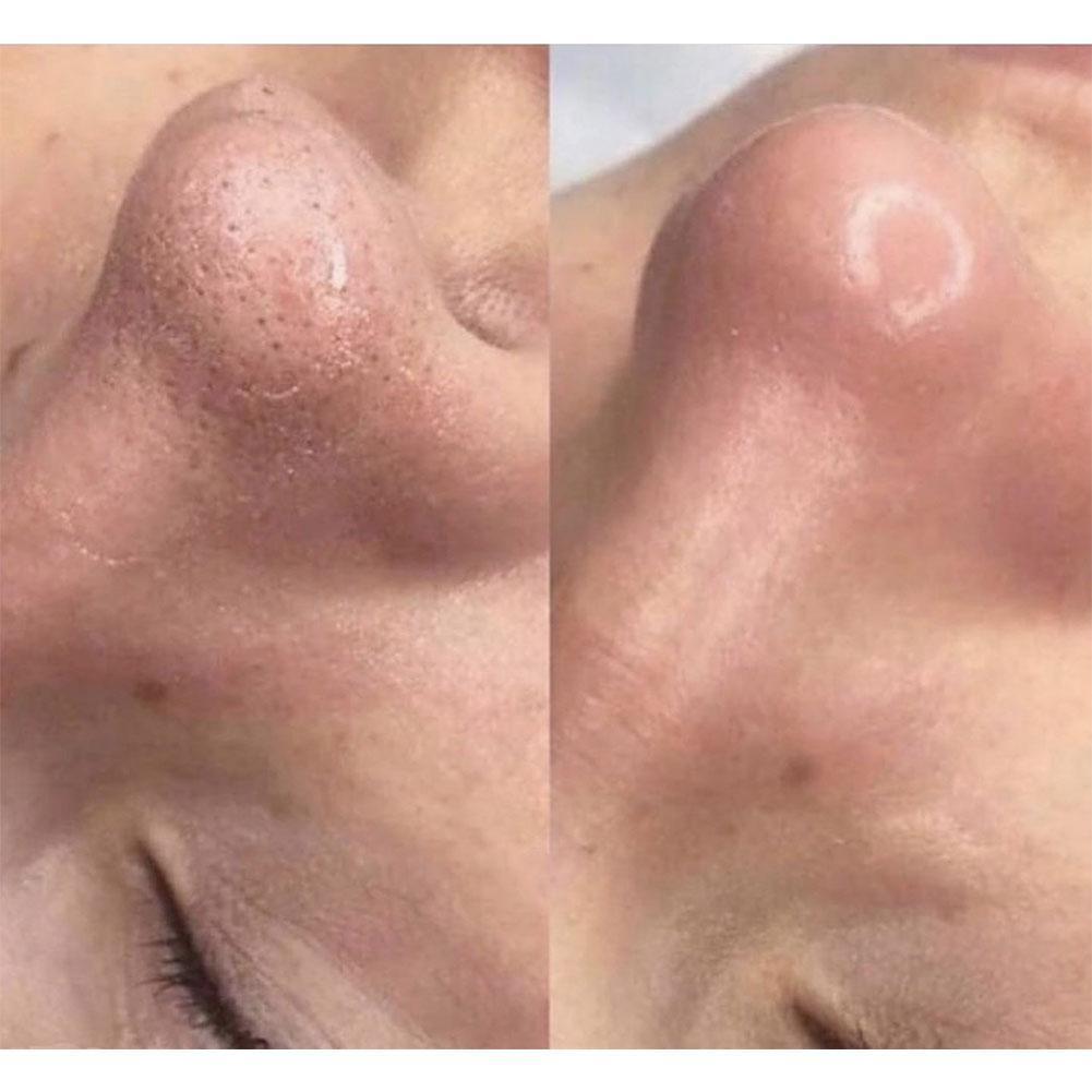 Процесс распаривания лица над паром